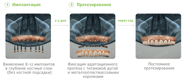одноэтапная имплантация верхней челюсти