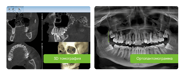 рентгеновские снимки зуба мудрости