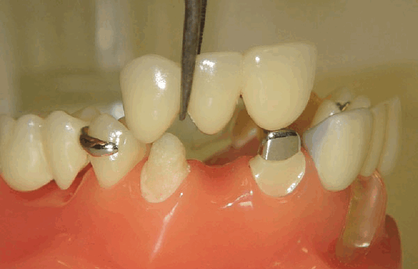 Подготовка к протезированию зубов (kornident.ru)