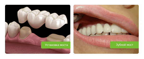 протезирование зубным мостом