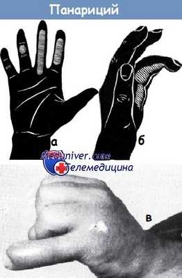 Панариций
