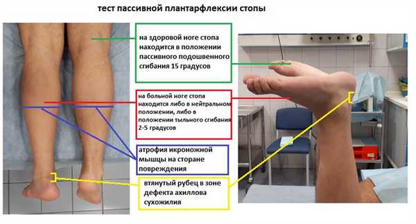 разрыв ахиллова сухожилия симптомы