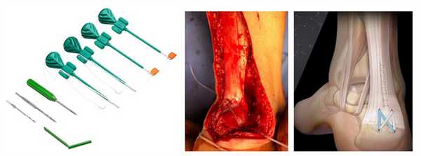 фиксация ахиллова сухожилия к пяточной кости Speed Bridge