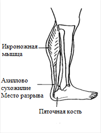 Ахиллово сухожилие