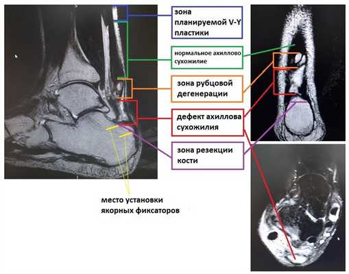 разрыв ахиллова сухоижилия МРТ
