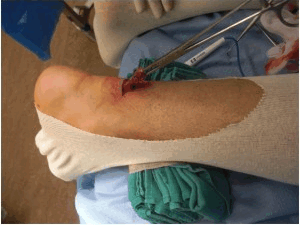 Рисунок 2: миниинвазивный метод востановления ахиллова сухожилия