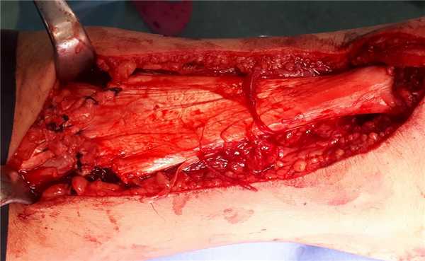 v-y пластика ахиллова сухожилия