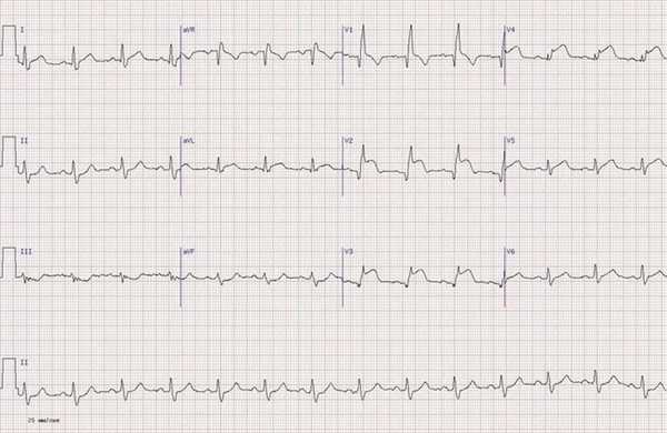 Переднеперегородочный инфаркт миокарда на ЭКГ