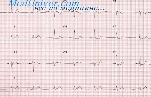 стадии инфаркта миокарда
