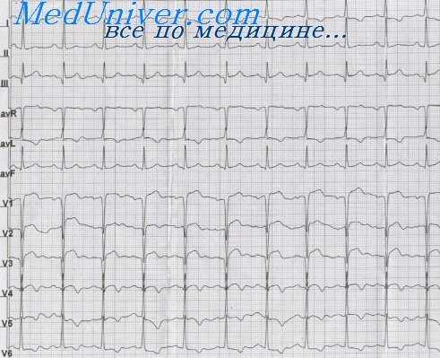 инфаркт миокарда