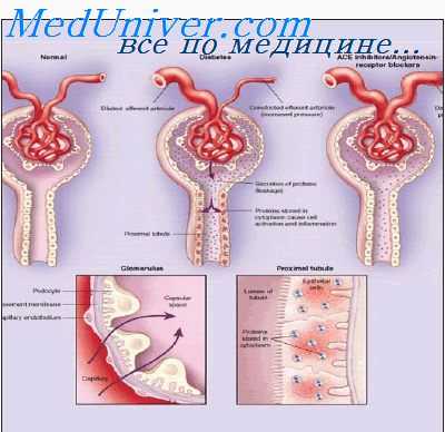 тубулярный синдром