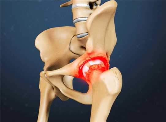 Бурсит тазобедренного сустава: симптомы и лечение