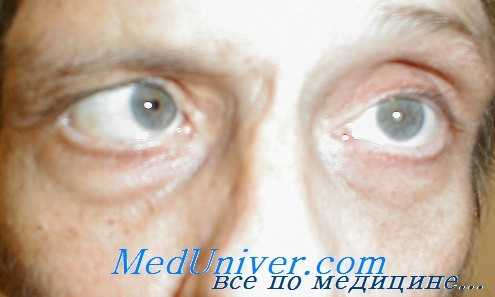 паралич отводящего нерва