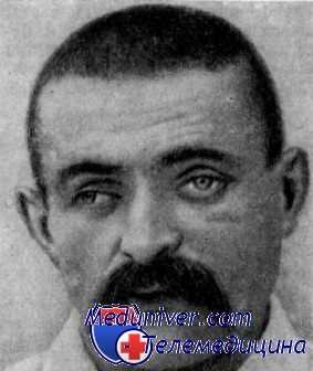 поражение глазодвигательного нерва