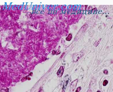 туберкулез органов