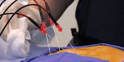 Радиочастотная абляция