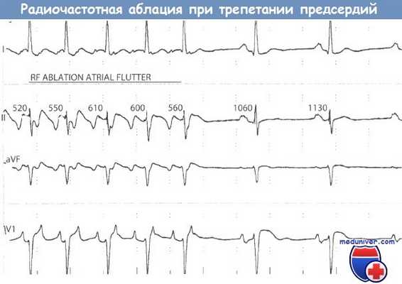 Катетерная радиочастотая аблация при трепетании предсердий (ТП)