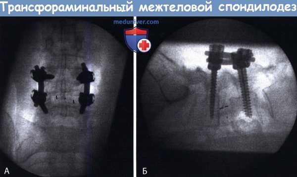 Трансфораминальный межтеловой спондилодез поясничного отдела позвоночника