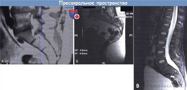 Пресакральное пространство