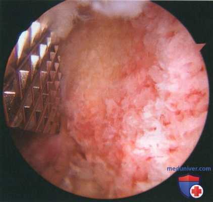 Артроскопическая резекция дистального конца ключицы