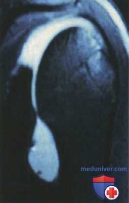 Открытая стабилизация передненижней нестабильности плечевого сустава