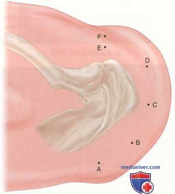 Артроскопическая операция при кальцифицирующем тендините плечевого сустава