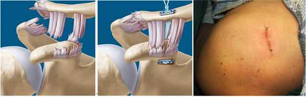 фиксация ключицы по методике MINAR