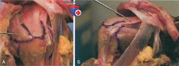 Артроскопическая операция при кальцифицирующем тендините плечевого сустава