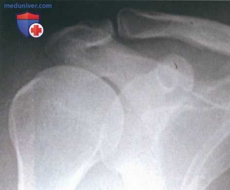 Артроскопическая резекция дистального конца ключицы