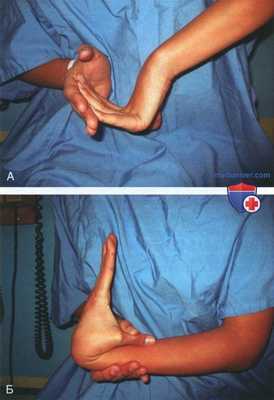 Открытая стабилизация передненижней нестабильности плечевого сустава