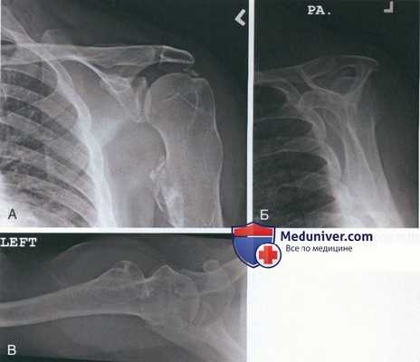 Артроскопическая операция при кальцифицирующем тендините плечевого сустава