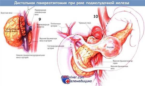 Методика операции дистальной панкреатэктомии при раке поджелудочной железы