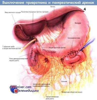 Методика выключения привратника, панкреатического дренажа при травме