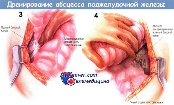 Методика дренирования абсцесса поджелудочной железы