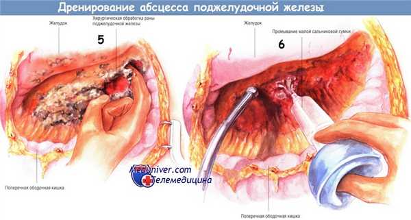 Методика дренирования абсцесса поджелудочной железы