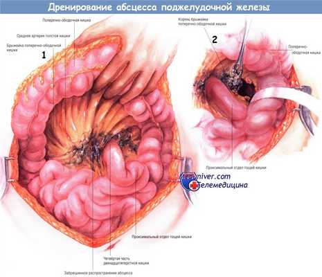 Методика дренирования абсцесса поджелудочной железы