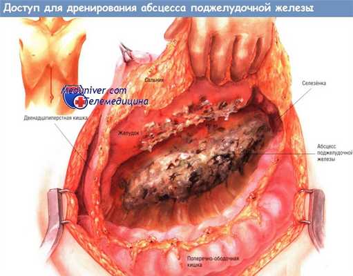 Оперативный доступ для дренирования абсцесса поджелудочной железы
