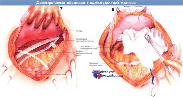 Методика дренирования абсцесса поджелудочной железы
