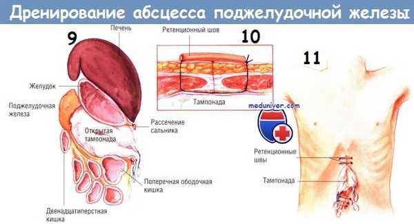 Методика дренирования абсцесса поджелудочной железы