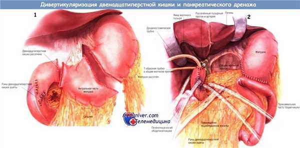 Методика операции дивертикуляризации двенадцатиперстной кишки и панкреатического дренажа при травме