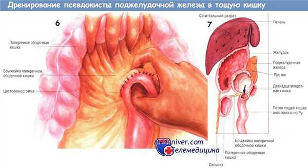 Методика дренирования псевдокисты поджелудочной железы в тощую кишку