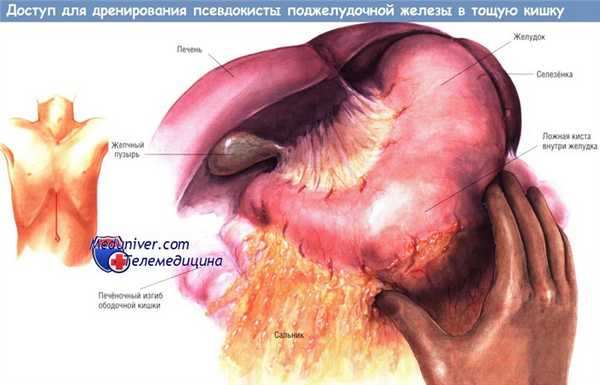 Доступ для дренирования псевдокисты поджелудочной железы в тощую кишку