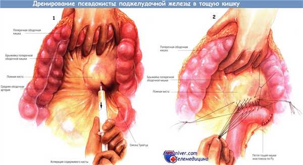 Методика дренирования псевдокисты поджелудочной железы в тощую кишку
