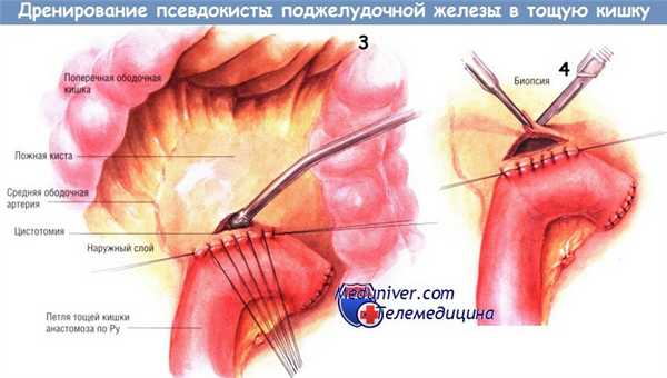 Методика дренирования псевдокисты поджелудочной железы в тощую кишку