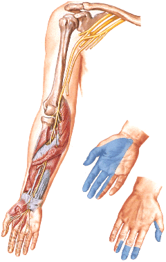 Срединный нерв и зоны чувствительных расстройств при его сдавлении на уровне запястного (карпального) канала.