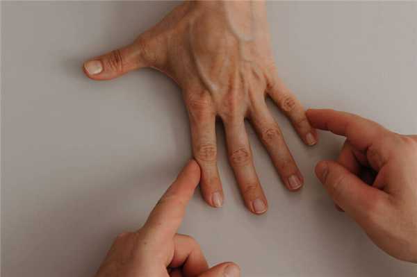 Лечение синдрома карпального канала