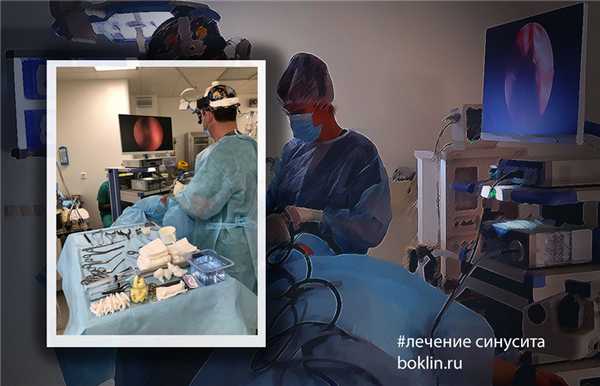 лечение синусита