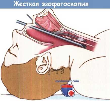 Жесткая эзофагоскопия