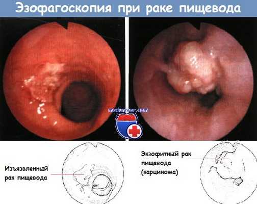 ФГДС при раке пищевода