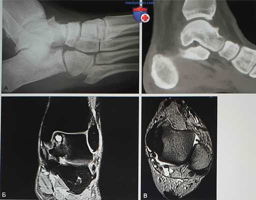 Операция при переднем импинджменте голеностопного сустава